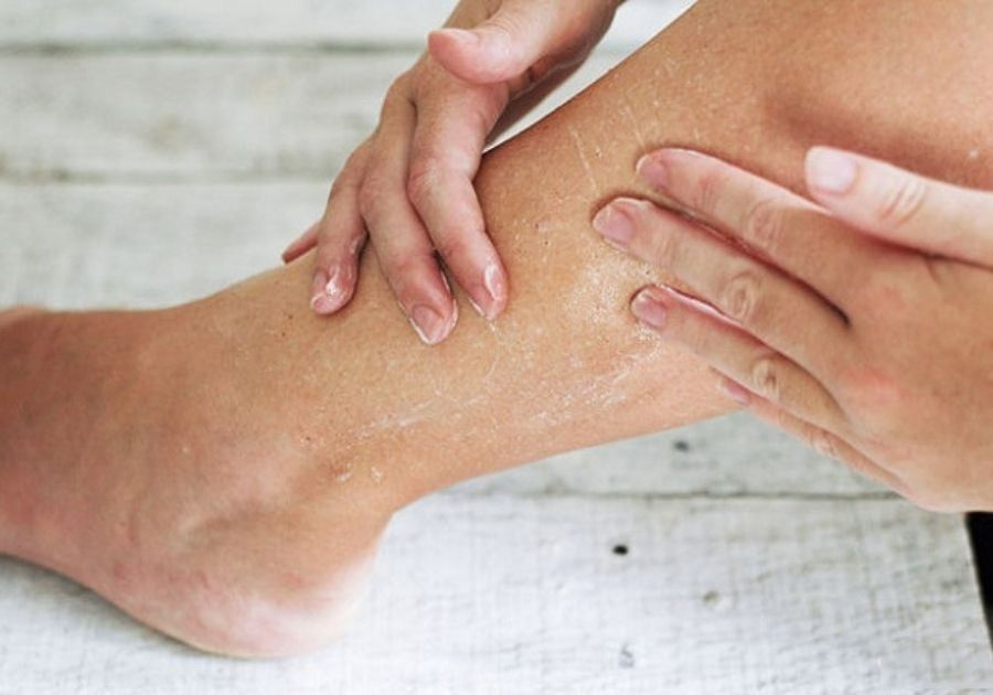 Khái niệm và dấu hiệu nhận biết da khô toàn thân