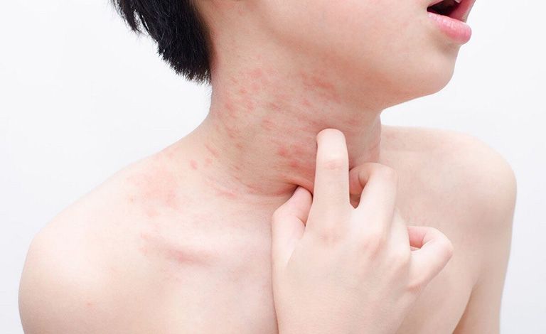 Cách xử lý khi bị dị ứng hải sản