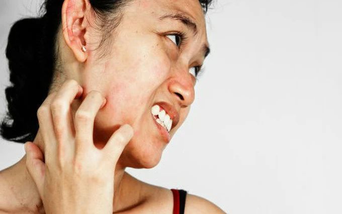 Cách phòng ngừa dị ứng hải sản