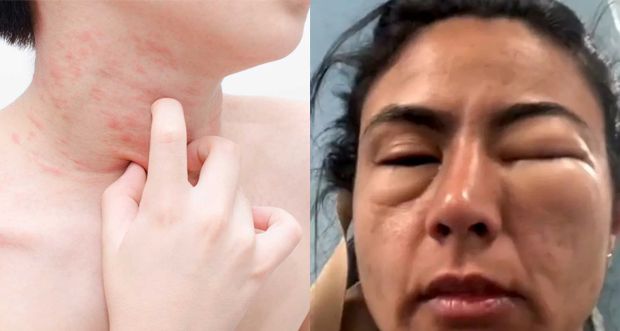 Không tự ý dùng thuốc mạnh như corticoid khi chưa có chỉ dẫn