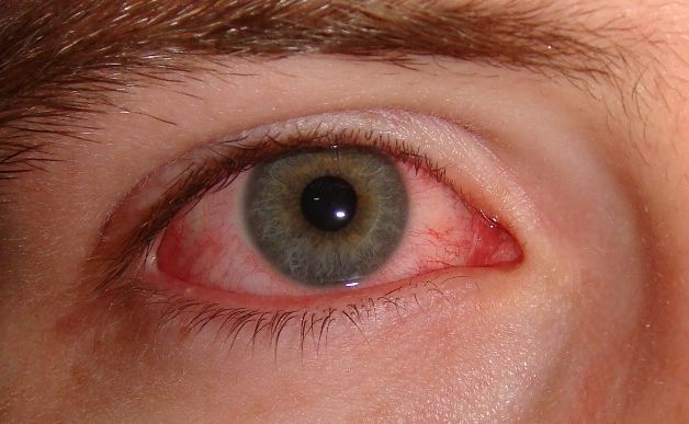 Nguyên nhân gây dị ứng mắt phổ biến nhất