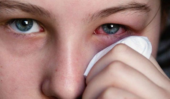 Cách điều trị dị ứng mắt hiệu quả