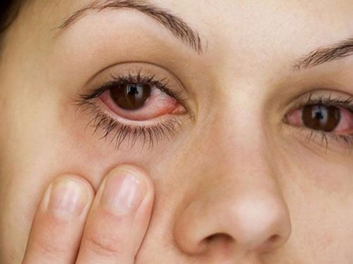 Cách phòng ngừa dị ứng mắt tái phát