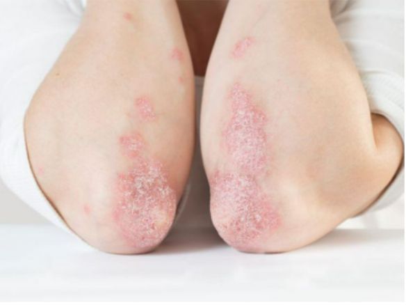 Triệu chứng cảnh báo sớm dễ bị bỏ qua