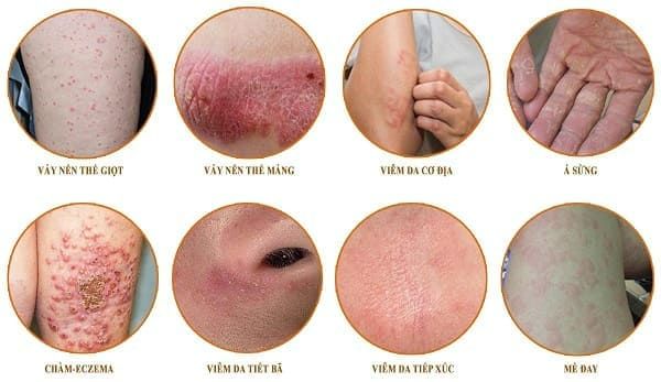 Bệnh tự miễn hầu hết là bệnh mạn tính và có xu hướng tiến triển âm thầm,