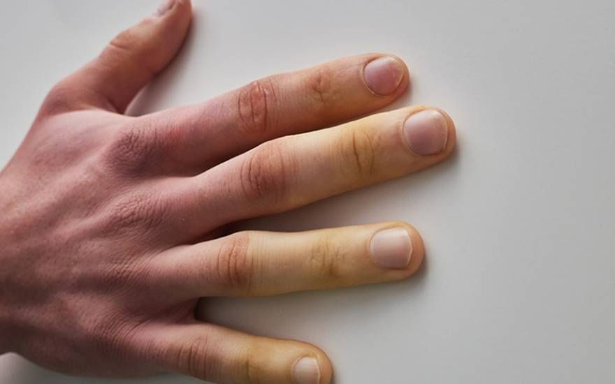 Quản lý và chăm sóc người bệnh xơ cứng bì