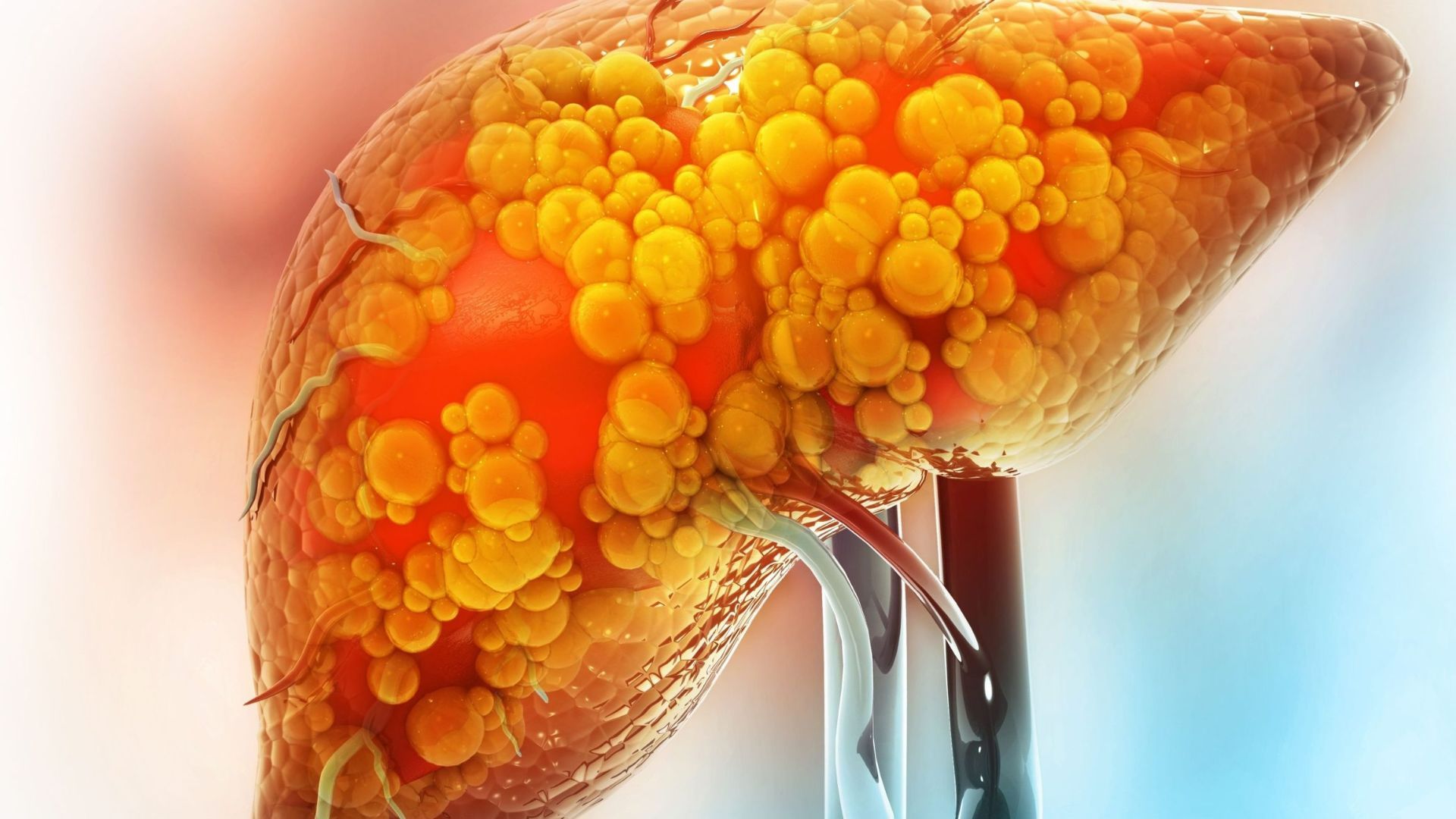 Gan nhiễm mỡ là gì và các cấp độ phổ biến