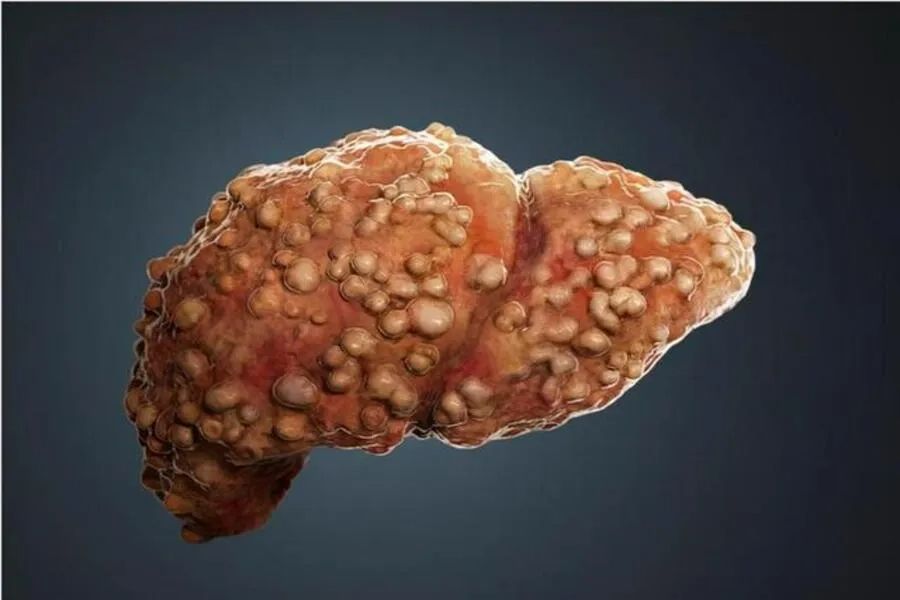 Giải đáp: Gan nhiễm mỡ có nguy hiểm không