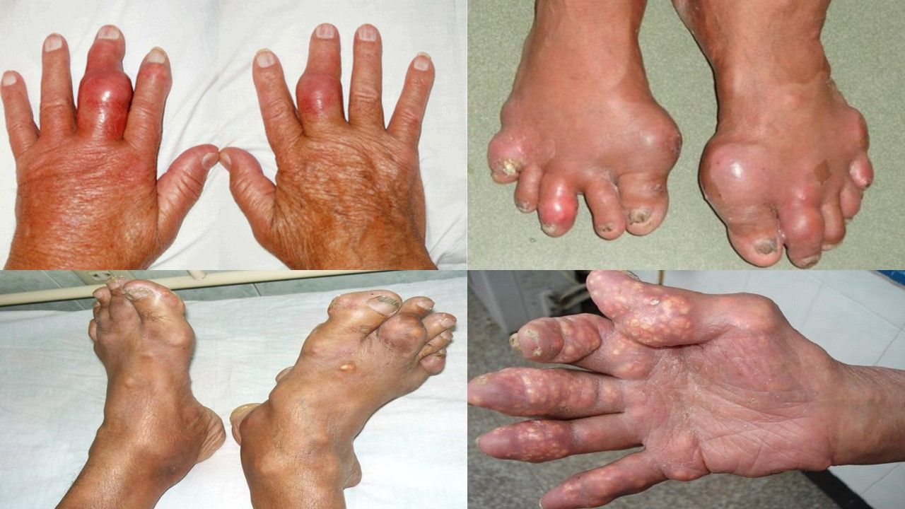 Khái niệm về bệnh gout