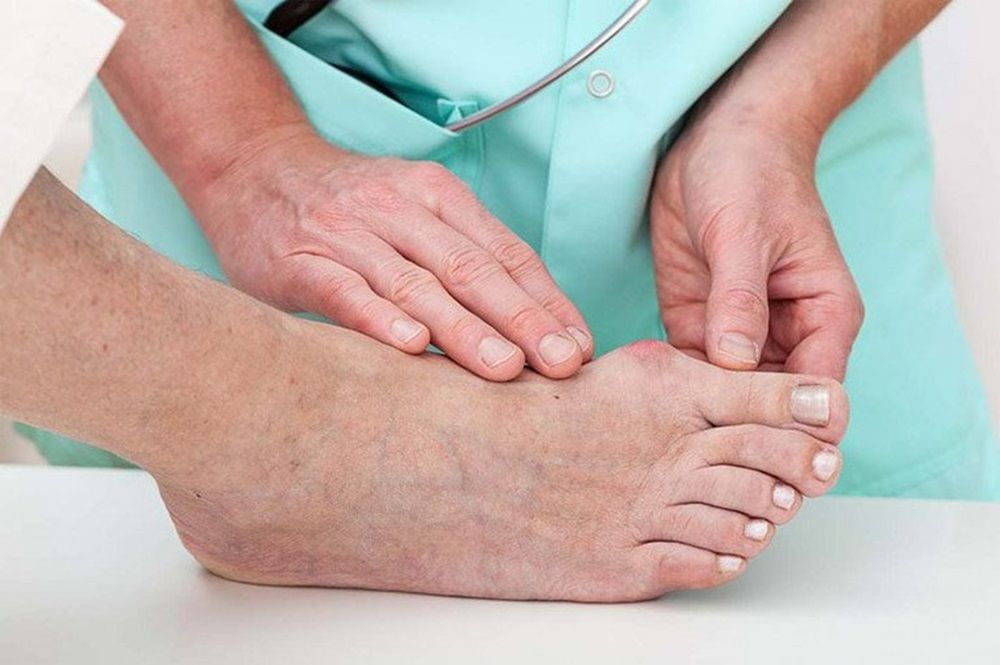 Người bị gout nên ăn gì để hạ axit uric