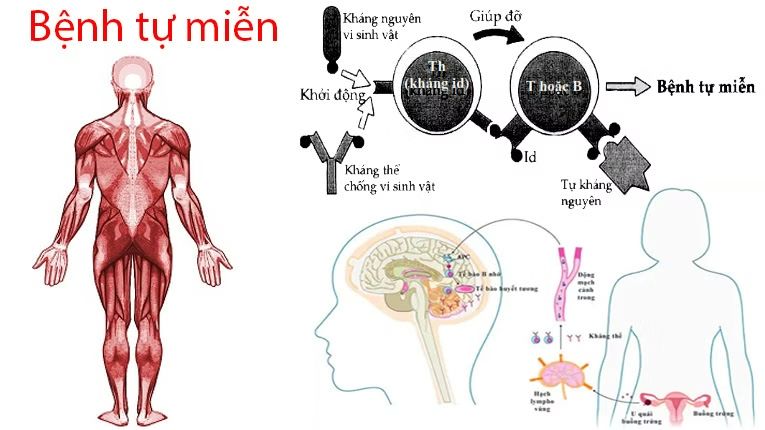 Nguyên nhân chính gây ra bệnh tự miễn