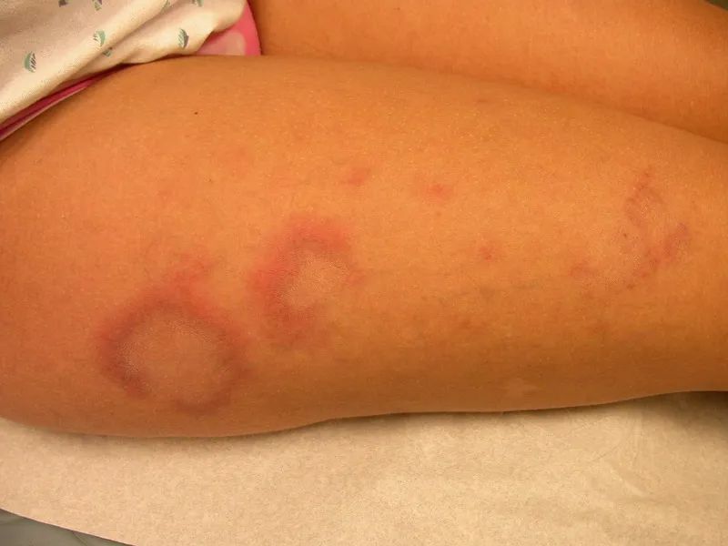 Triệu chứng điển hình của lupus ban đỏ dạng đĩa