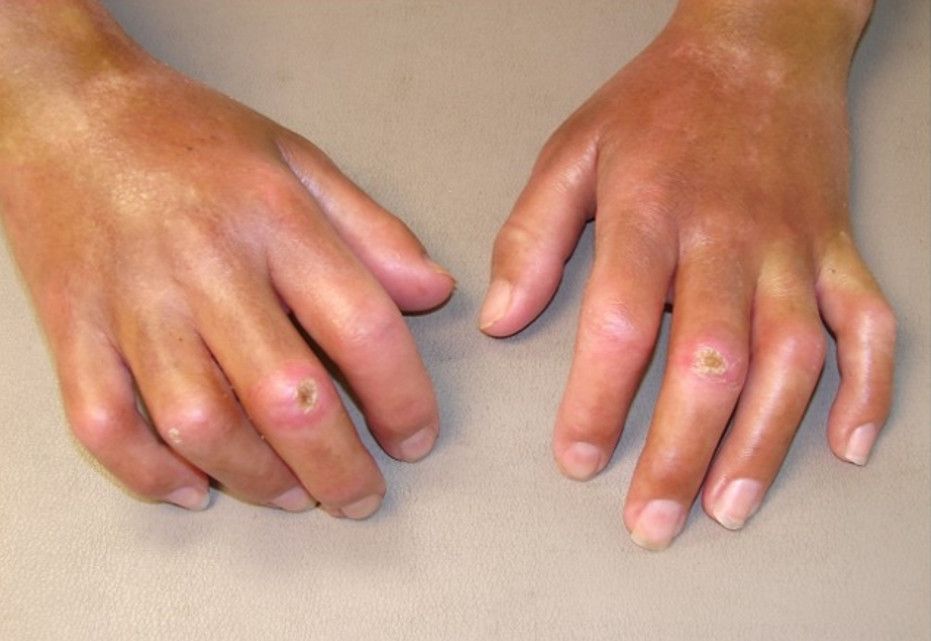 Chẩn đoán và phương pháp điều trị hiện nay